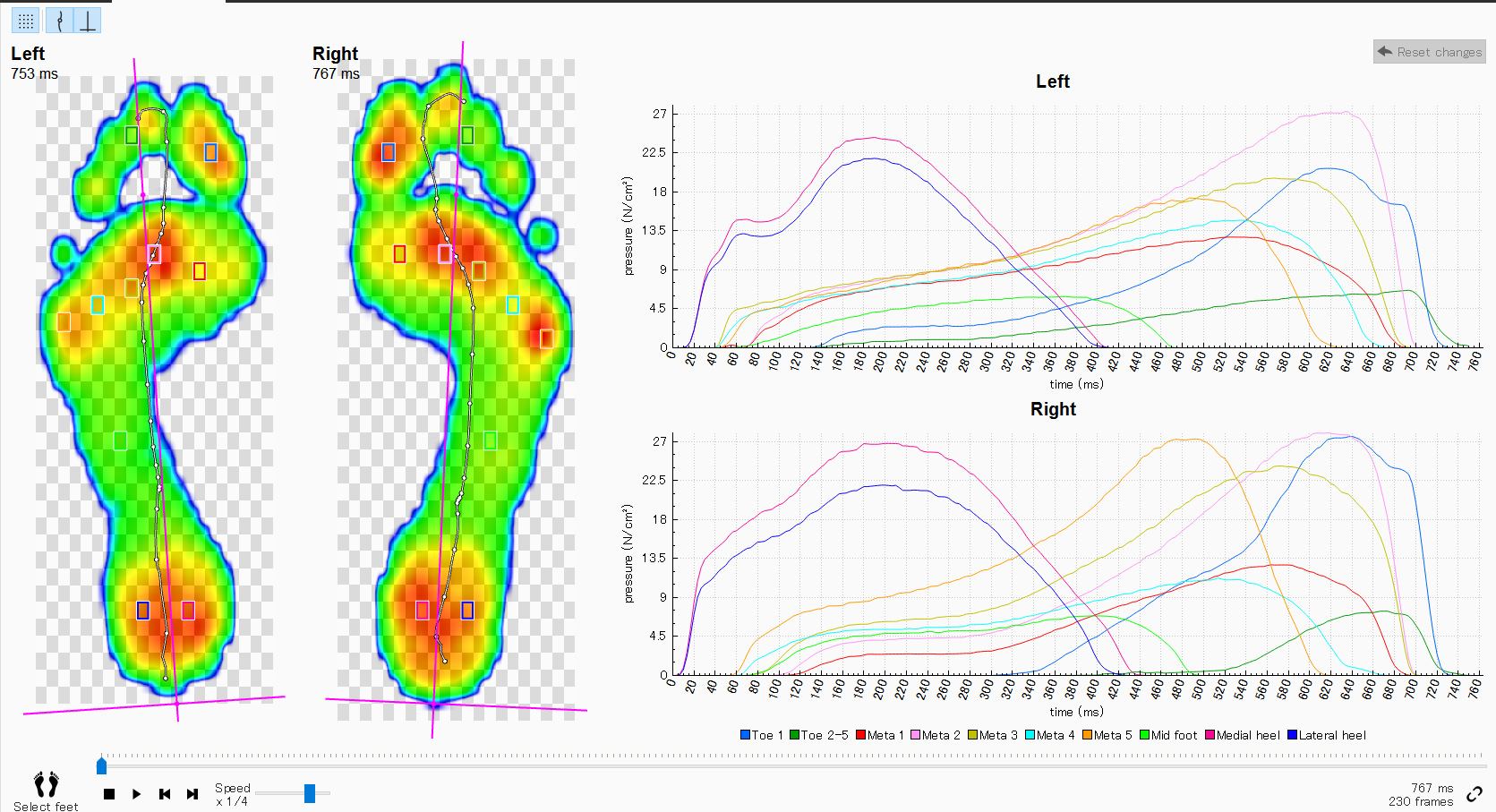 Digital pressure mapping during a gait assessment